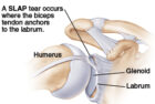 Shoulder Labral Injuries