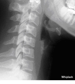 Whiplash c spine xray