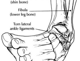 Ankle Sprains