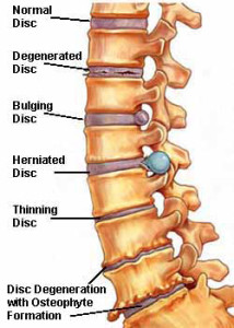 bulging-spine
