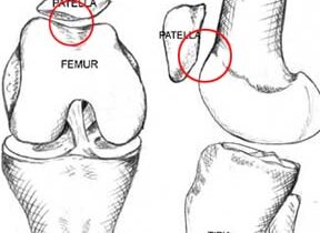 PatelloFemoral Joint Pain (Runner’s Knee)