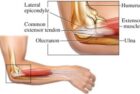 Tennis Elbow and Golfer’s Elbow