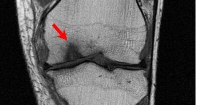 Arthroscopic Treatment of Osteochondritis Dissecans of the Knee