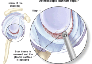 Arthroscopic Anterior Shoulder Stabilization